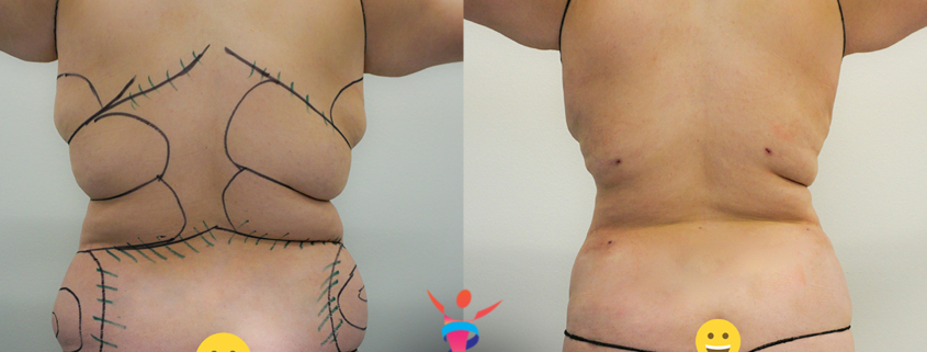 Liposuction